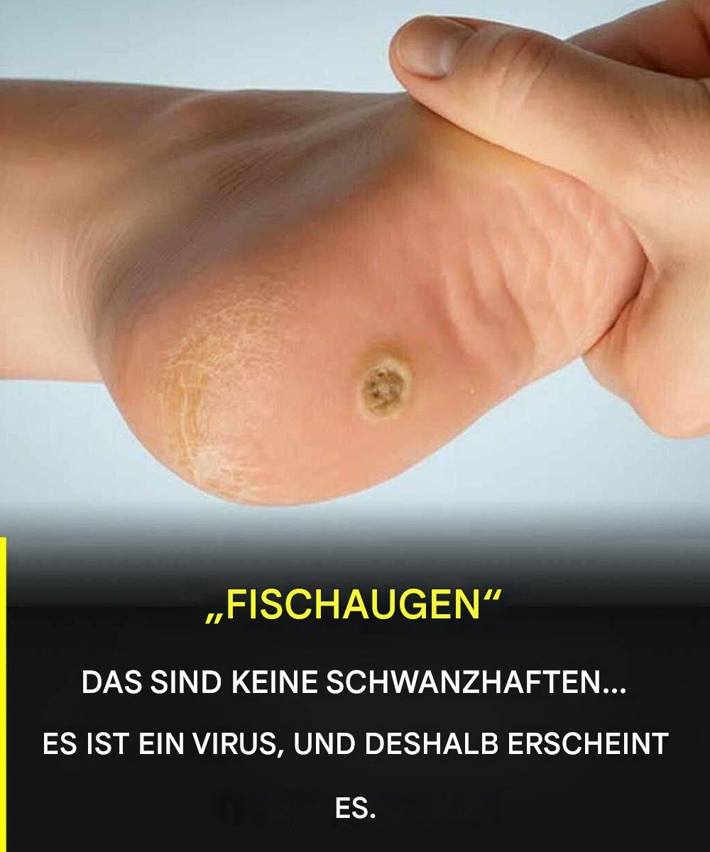 Fußwarzen: Was sie sind und warum sie nicht mit gewöhnlicher Hornhaut verwechselt werden sollten - BuzzDay