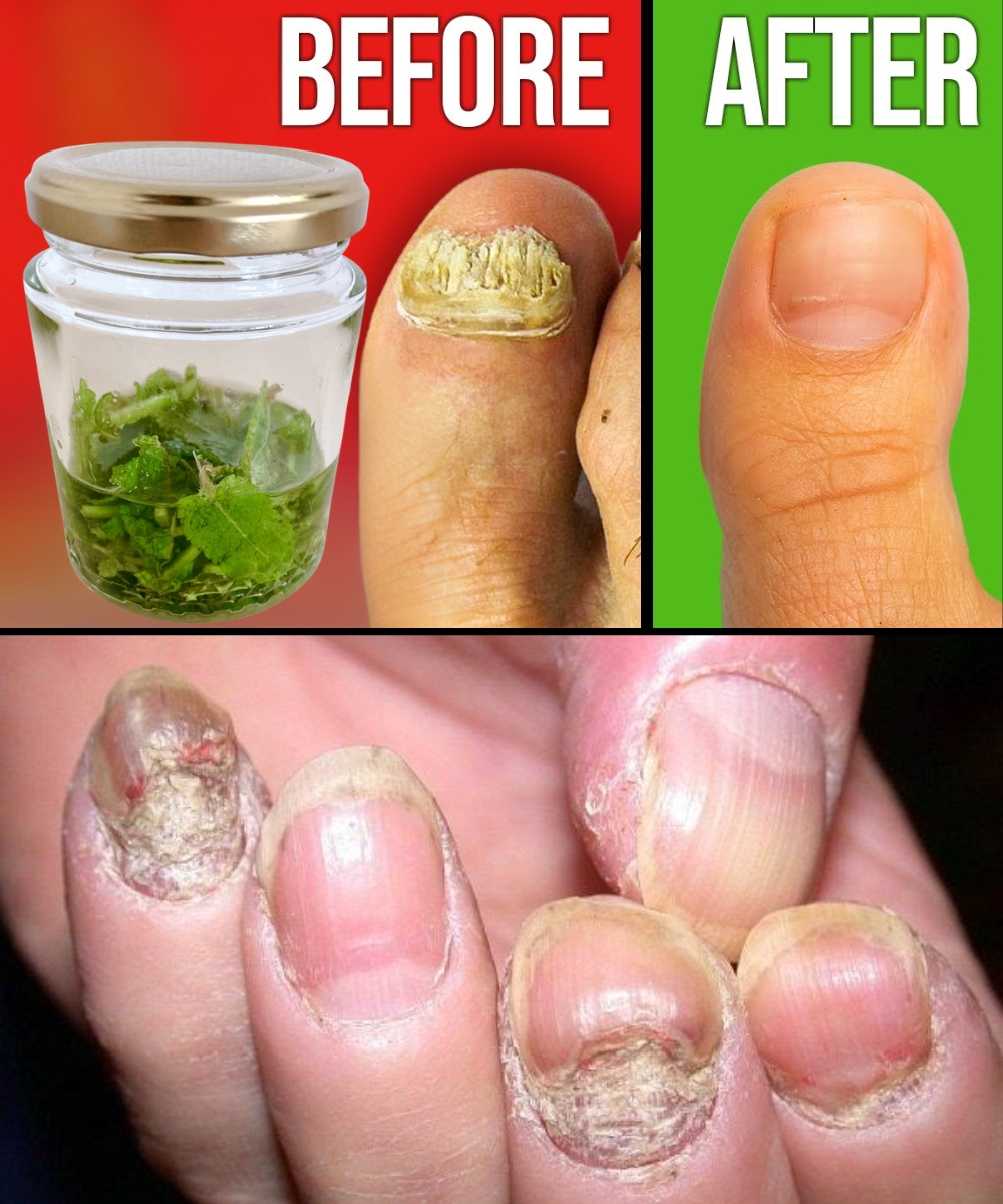 Discover the Secret of “Rompe Fungus”: Naturally Restore Healthy Nails! HYN - BuzzDay