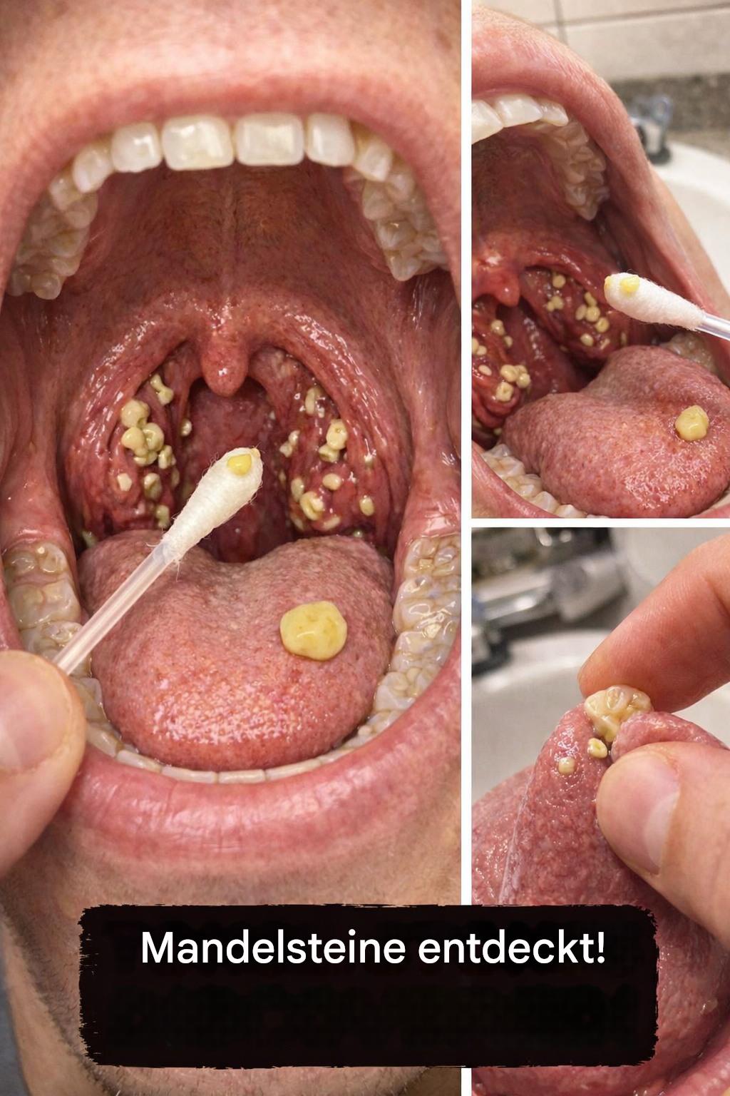 Warum Mundgeruch auch nach dem Zähneputzen anhält – Könnten Mandelsteine ​​die versteckte Ursache sein? - BuzzDay