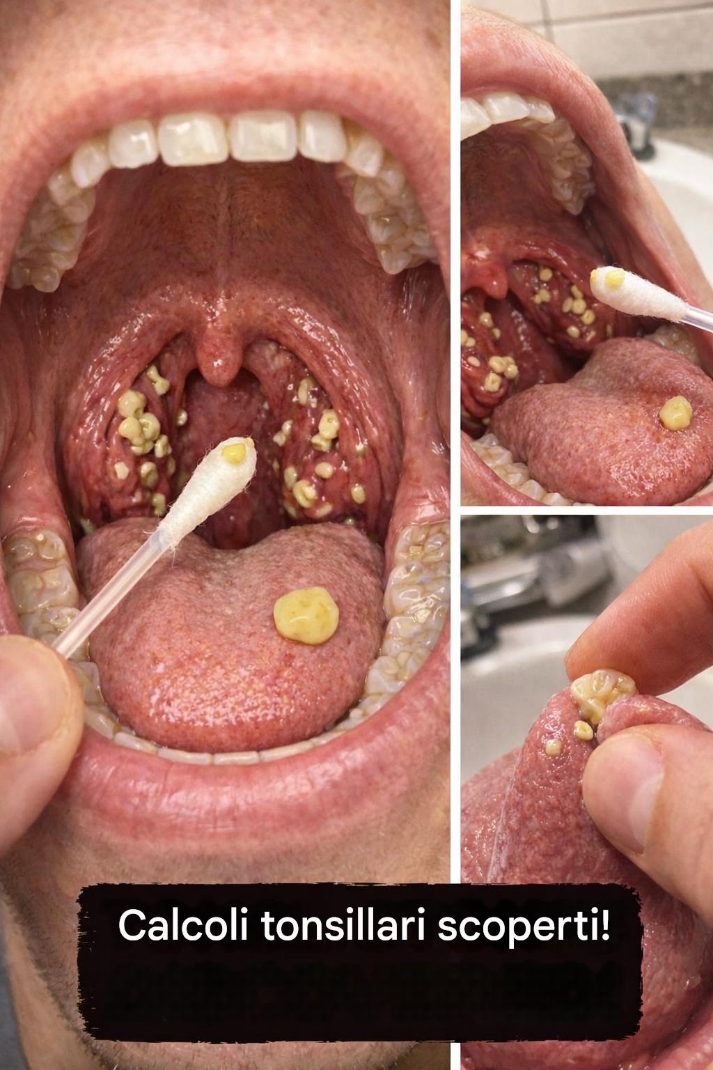 Perché l’alito cattivo persiste anche dopo aver lavato i denti? Potrebbero esserci calcoli tonsillari come causa? - BuzzDay