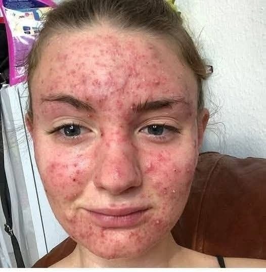 Der häufige Hautausschlag meines Mannes wurde zunächst als einfache Nahrungsmittelallergie diagnostiziert, bis eine routinemäßige Blutuntersuchung eine schwere und lebensbedrohliche Form von Blutkrebs aufdeckte. - BuzzDay